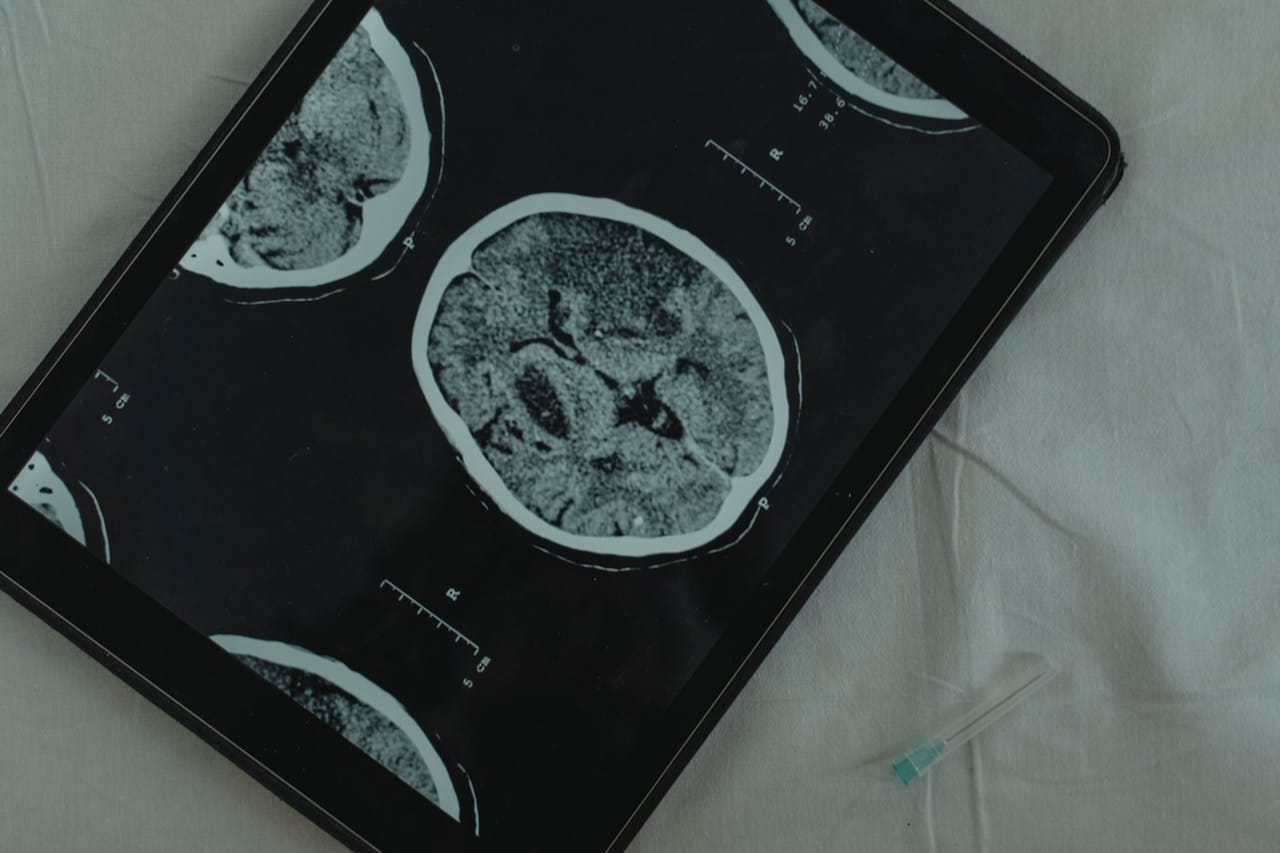 Microscopie à super-résolution. Tel-Aviv University : un pas de géant dans la lutte contre la maladie de Parkinson.