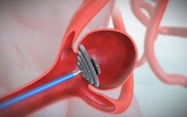 Santé : Le japonais Kaneka acquiert l’israélien EndoStream Medical.