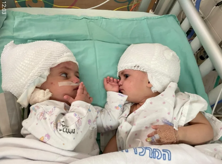 Israël : siamoises et reliées par la tête, deux sœurs ont pu se voir pour la première fois
