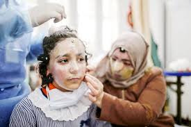A Gaza, des masques thérapeutiques sur mesure pour les grands brûlés.