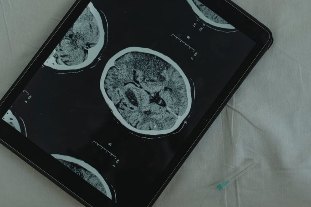 Microscopie à super-résolution. Tel-Aviv University : un pas de géant dans la lutte contre la maladie de Parkinson.